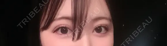 二重埋没 アリエル美容クリニック 横浜院 DAY 2 メイン用