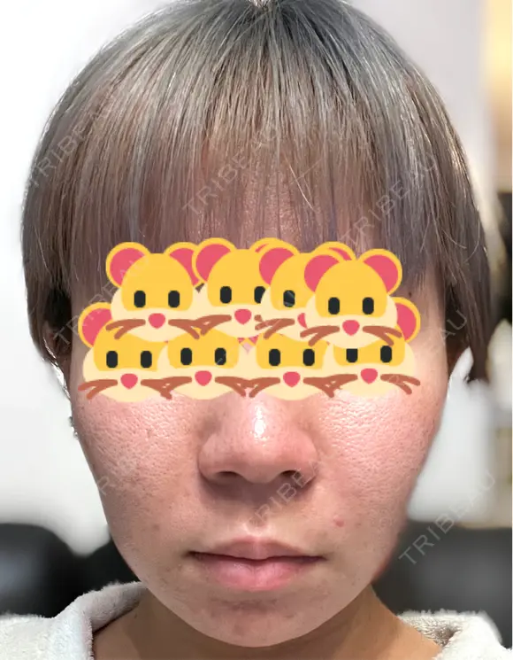 ヒアルロン酸注入（鼻） / ボルニューマ ルラ美容クリニック 上野院 DAY 2 メイン用