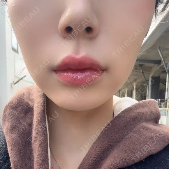 ヒアルロン酸注入（唇） Wing clinic 豊中駅前院 DAY 2 メイン用