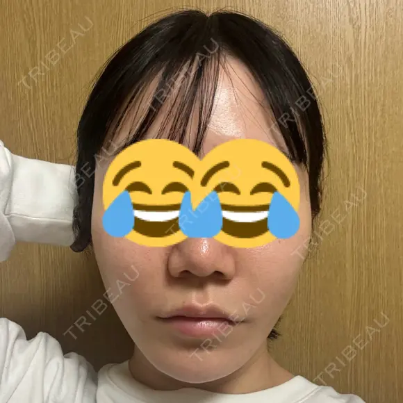 糸リフト BON BON CLINIC 銀座駅前本院 DAY 0 メイン用