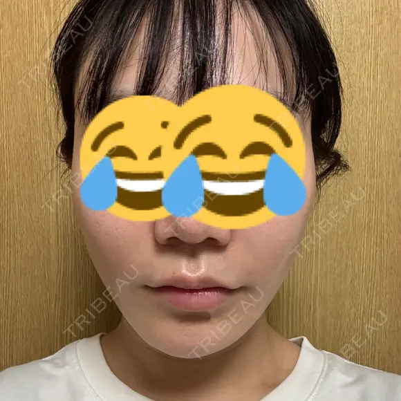 糸リフト BON BON CLINIC 銀座駅前本院 DAY 1 メイン用