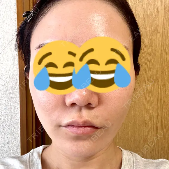 糸リフト BON BON CLINIC 銀座駅前本院 AFTER メイン用
