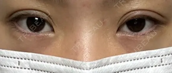 二重埋没 湘南美容クリニック 千葉センシティ院 DAY 4 メイン用