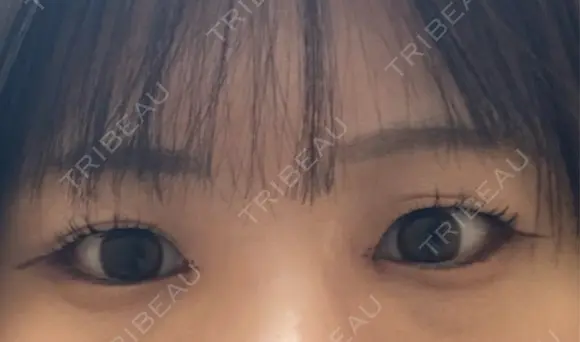 目頭切開 Stand by Beauty Clinic DAY 4 メイン用