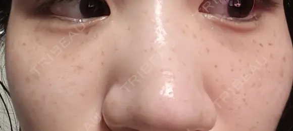 ルメッカ やさしい美容皮膚科・皮フ科　秋葉原院 AFTER メイン用
