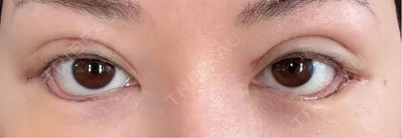 二重埋没 / 目尻切開 / タレ目形成・グラマラスライン（切開） / 自然癒着法 Stand by Beauty Clinic DAY 6 メイン用