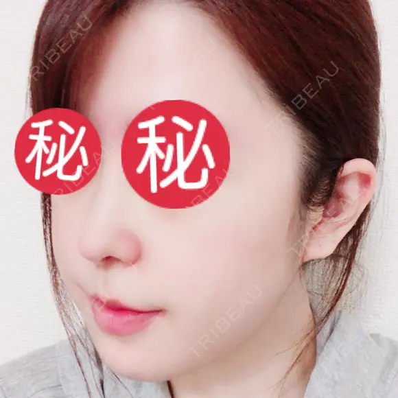 鼻中隔延長（切開） / 骨切り（あご） / 骨削り（エラ） / 軟骨移植 / 眉間プロテーゼ id（アイディ）美容外科 DAY 15 メイン用