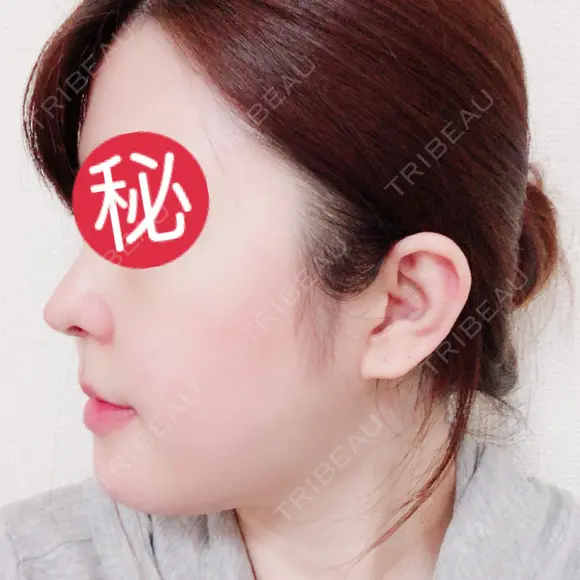 鼻中隔延長（切開） / 骨切り（あご） / 骨削り（エラ） / 軟骨移植 / 眉間プロテーゼ id（アイディ）美容外科 DAY 15 メイン用