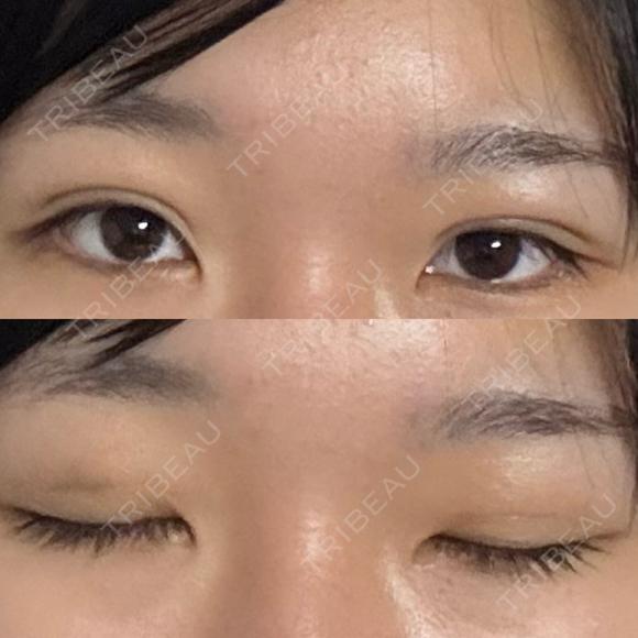 二重埋没 湘南美容クリニック 千葉センシティ院 AFTER メイン用