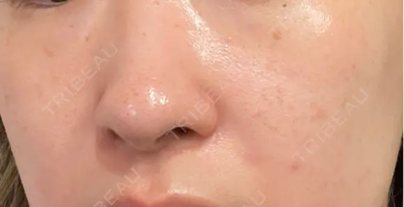 ルメッカ / LDM・インテンスウルトラ Chloe Cheongdam Clinic （クロエチョンダムクリニック） DAY 6 メイン用