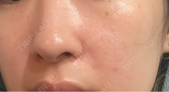 ルメッカ / LDM・インテンスウルトラ Chloe Cheongdam Clinic （クロエチョンダムクリニック） DAY 4 メイン用