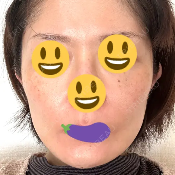 切開リフト GRACY TOKYO CLINIC【グレイシートウキョウクリニック】 DAY 16 メイン用