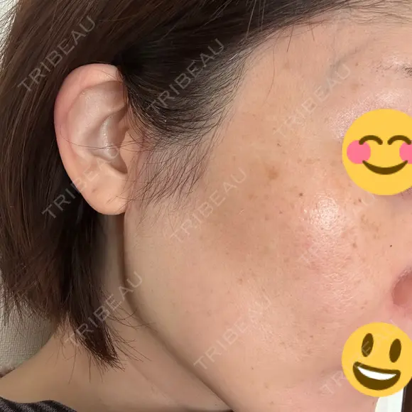 切開リフト GRACY TOKYO CLINIC【グレイシートウキョウクリニック】 DAY 16 メイン用