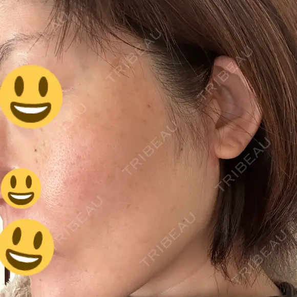 切開リフト GRACY TOKYO CLINIC【グレイシートウキョウクリニック】 DAY 16 メイン用