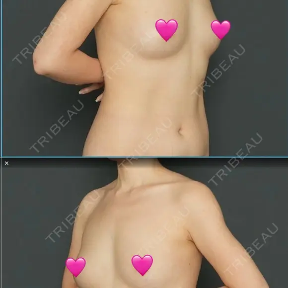 脂肪吸引（二の腕） / 脂肪吸引（脚） / 豊胸（脂肪注入） Lipo Clinic omotesando AFTER メイン用