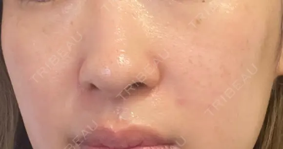 ルメッカ / LDM・インテンスウルトラ Chloe Cheongdam Clinic （クロエチョンダムクリニック） DAY 5 メイン用