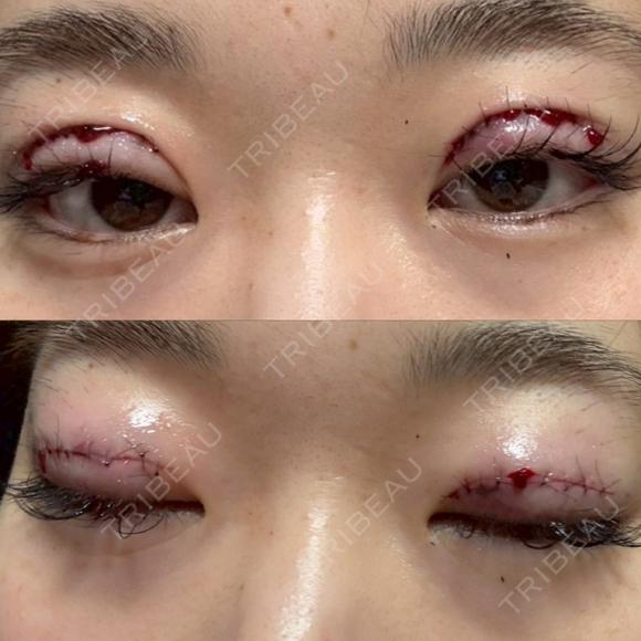 二重切開 つだ美容外科クリニック AFTER メイン用