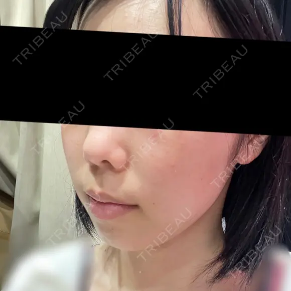 光治療（フォトフェイシャルなど） トラスト美容クリニック 銀座院 DAY 60 メイン用