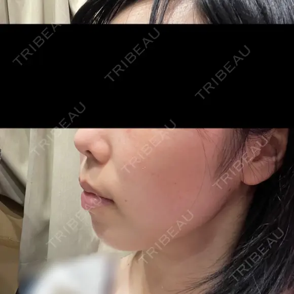光治療（フォトフェイシャルなど） トラスト美容クリニック 銀座院 DAY 60 メイン用