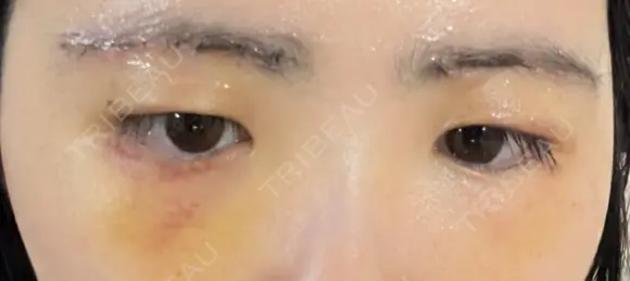上まぶたの脂肪取り / 眉下切開 新宿美容外科ネビュラクリニック DAY 7 メイン用