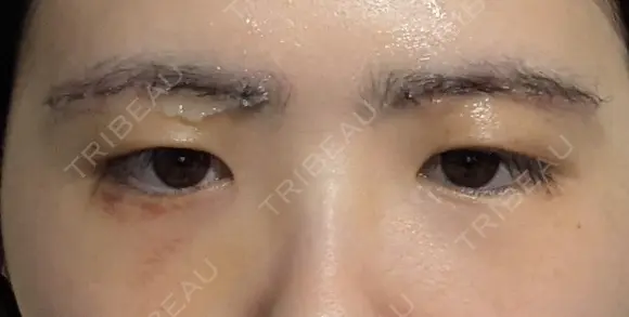 上まぶたの脂肪取り / 眉下切開 新宿美容外科ネビュラクリニック DAY 9 メイン用