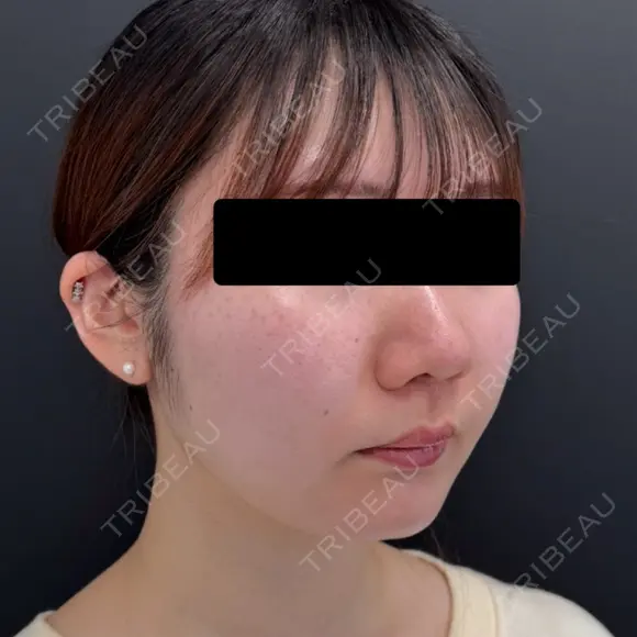 糸リフト / ジョールファット除去 BLINC CLINIC （ブリンク クリニック） DAY 92 メイン用