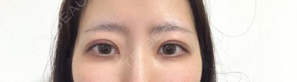二重切開 / 目頭切開 / 眼瞼下垂（切開） LUHO（ルホ）美容外科 DAY 96 メイン用
