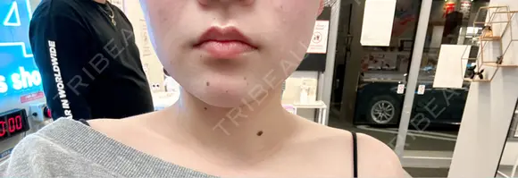 ボトックス（エラ・小顔） / ボトックス（肩） アリエル美容クリニック 水戸院 DAY 14 メイン用