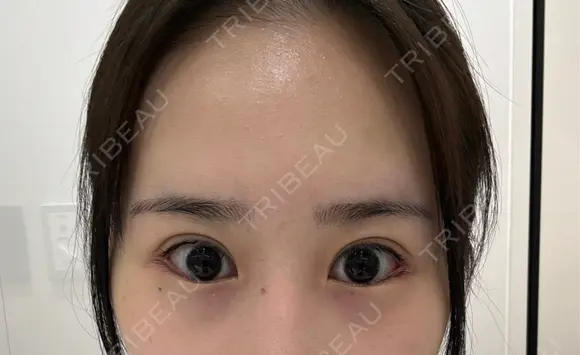 目尻切開 / タレ目形成・グラマラスライン（切開） BIANCA銀座 AFTER メイン用