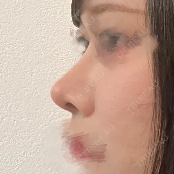 鼻尖形成（切開） / 小鼻縮小（切開） / ワシ鼻修正・ハンプ切除 / 鼻修正 / 鼻尖縮小 / 真皮移植 LUHO（ルホ）美容外科 DAY 113 メイン用