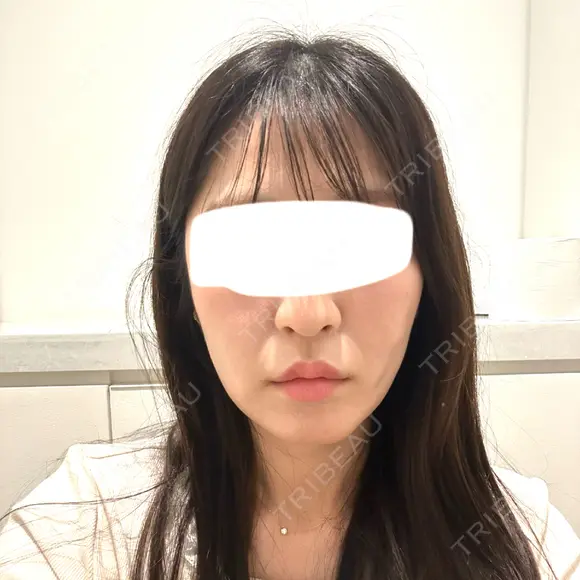 脂肪吸引注射（顔） 新宿美容外科ネビュラクリニック AFTER メイン用