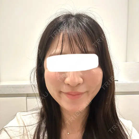 脂肪吸引注射（顔） 新宿美容外科ネビュラクリニック DAY 37 メイン用
