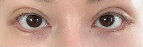 二重埋没 / 目尻切開 / タレ目形成・グラマラスライン（切開） / 自然癒着法 Stand by Beauty Clinic DAY 9 メイン用
