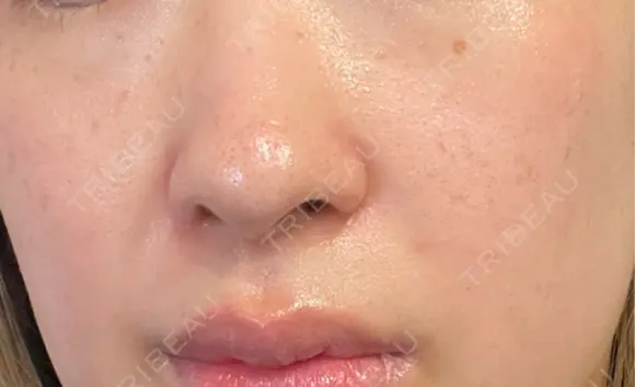 ルメッカ / LDM・インテンスウルトラ Chloe Cheongdam Clinic （クロエチョンダムクリニック） DAY 7 メイン用