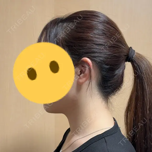 その他（輪郭） おおかみ美容のクリニック 新宿院 DAY 7 メイン用
