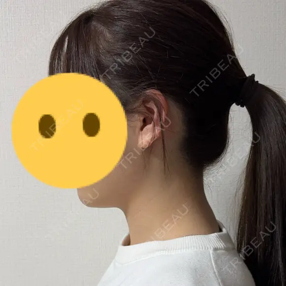 その他（輪郭） おおかみ美容のクリニック 新宿院 AFTER メイン用