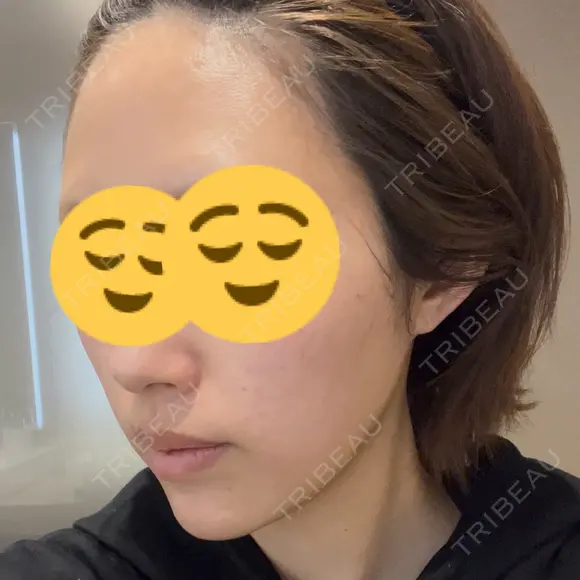 光治療（フォトフェイシャルなど） トラスト美容クリニック 銀座院 DAY 0 メイン用