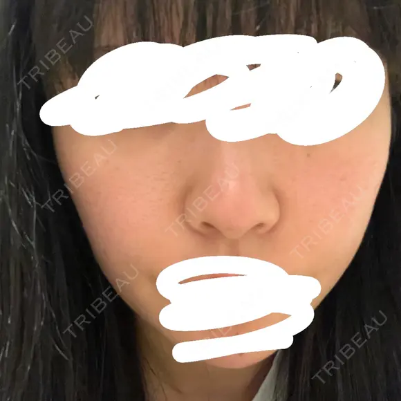 肌ヒアルロン酸注入（たるみ・シワ改善） / ボトックス（額） TCB東京中央美容外科 佐賀院 AFTER メイン用