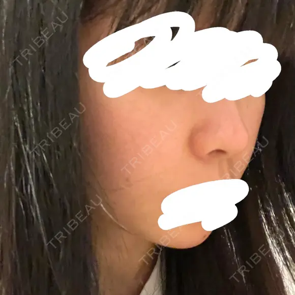 肌ヒアルロン酸注入（たるみ・シワ改善） / ボトックス（額） TCB東京中央美容外科 佐賀院 DAY 1 メイン用