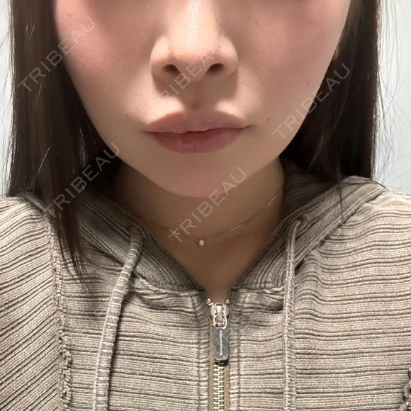 バッカルファット除去 / 脂肪吸引（顔） / あご下筋肉縛り セギム美容整形外科 DAY 15 メイン用