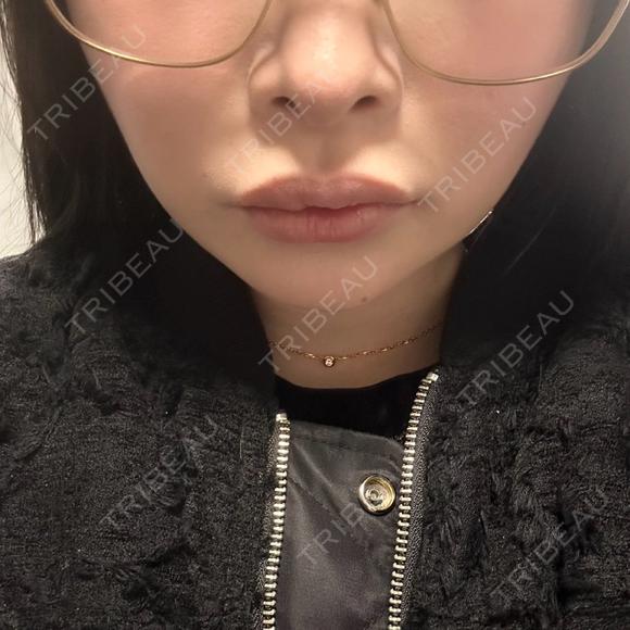バッカルファット除去 / 脂肪吸引（顔） / あご下筋肉縛り セギム美容整形外科 DAY 31 メイン用