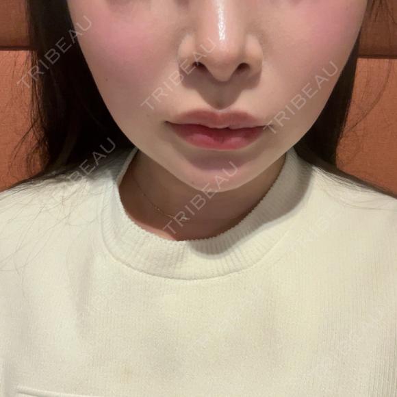 バッカルファット除去 / 脂肪吸引（顔） / あご下筋肉縛り セギム美容整形外科 AFTER メイン用