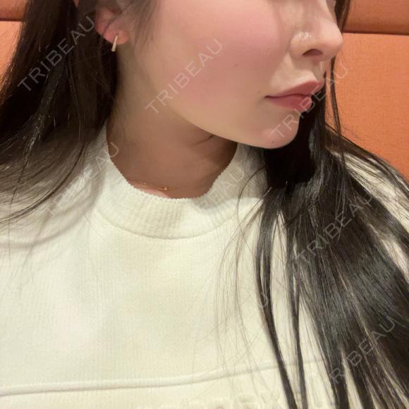 バッカルファット除去 / 脂肪吸引（顔） / あご下筋肉縛り セギム美容整形外科 DAY 91 メイン用