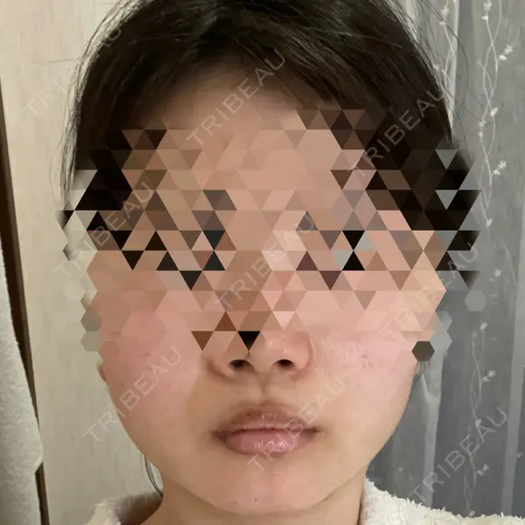 糸リフト / 脂肪吸引注射（顔） / ボトックス（あご） / ボトックス（エラ・小顔） / ボトックス（肩） TCB東京中央美容外科 立川院 DAY 3 メイン用