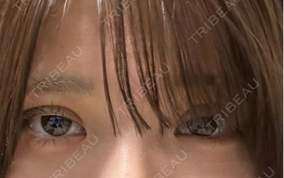 二重埋没 / ヒアルロン酸注入（涙袋） / ヒアルロン酸注入（あご） アリエル美容クリニック 郡山院 DAY 21 メイン用