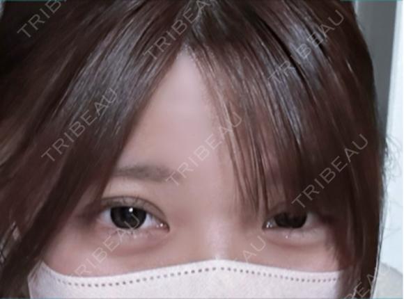 二重埋没 / ヒアルロン酸注入（涙袋） / ヒアルロン酸注入（あご） アリエル美容クリニック 郡山院 DAY 35 メイン用