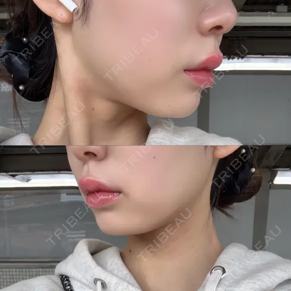 ヒアルロン酸注入（唇） Wing clinic 豊中駅前院 DAY 7 メイン用