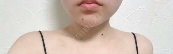 ボトックス（エラ・小顔） / ボトックス（肩） アリエル美容クリニック 水戸院 DAY 18 メイン用