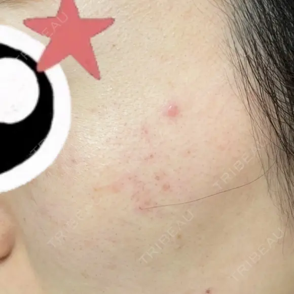 ルメッカ / LDM・インテンスウルトラ Chloe Cheongdam Clinic （クロエチョンダムクリニック） DAY 0 メイン用