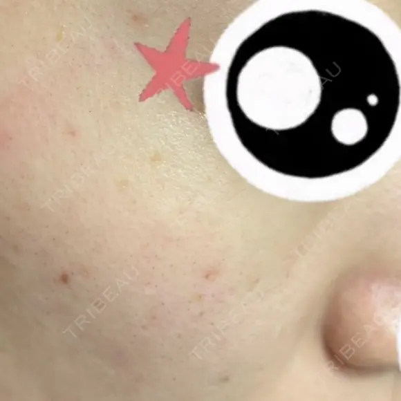ルメッカ / LDM・インテンスウルトラ Chloe Cheongdam Clinic （クロエチョンダムクリニック） DAY 0 メイン用
